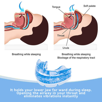 Anti-Snore Mouth Guard – photo 3