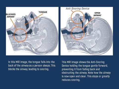 Anti Snore Tongue Device – photo 4
