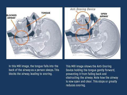Anti Snore Tongue Device – photo 4