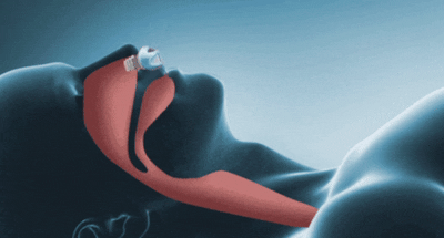Mini Anti-Snoring Device – photo 6