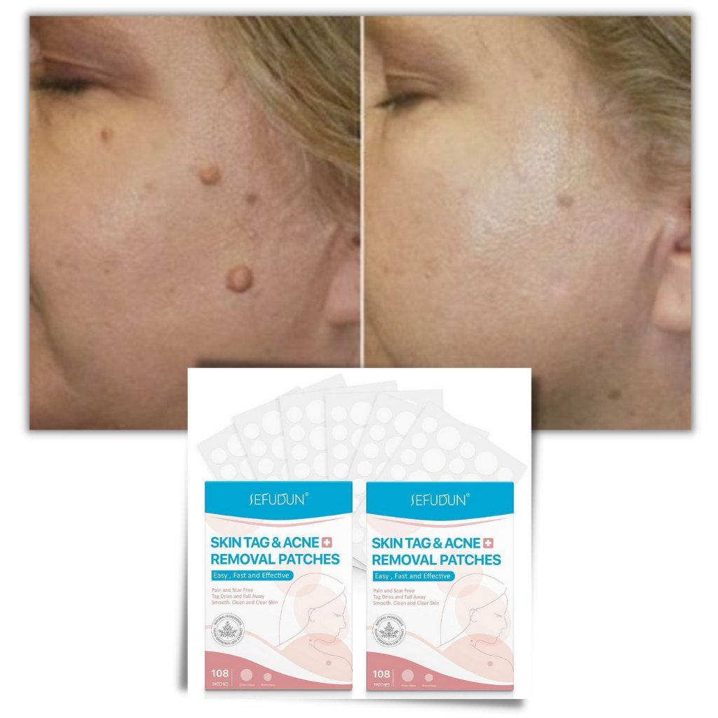Skin Tag Removal Patches – photo 7