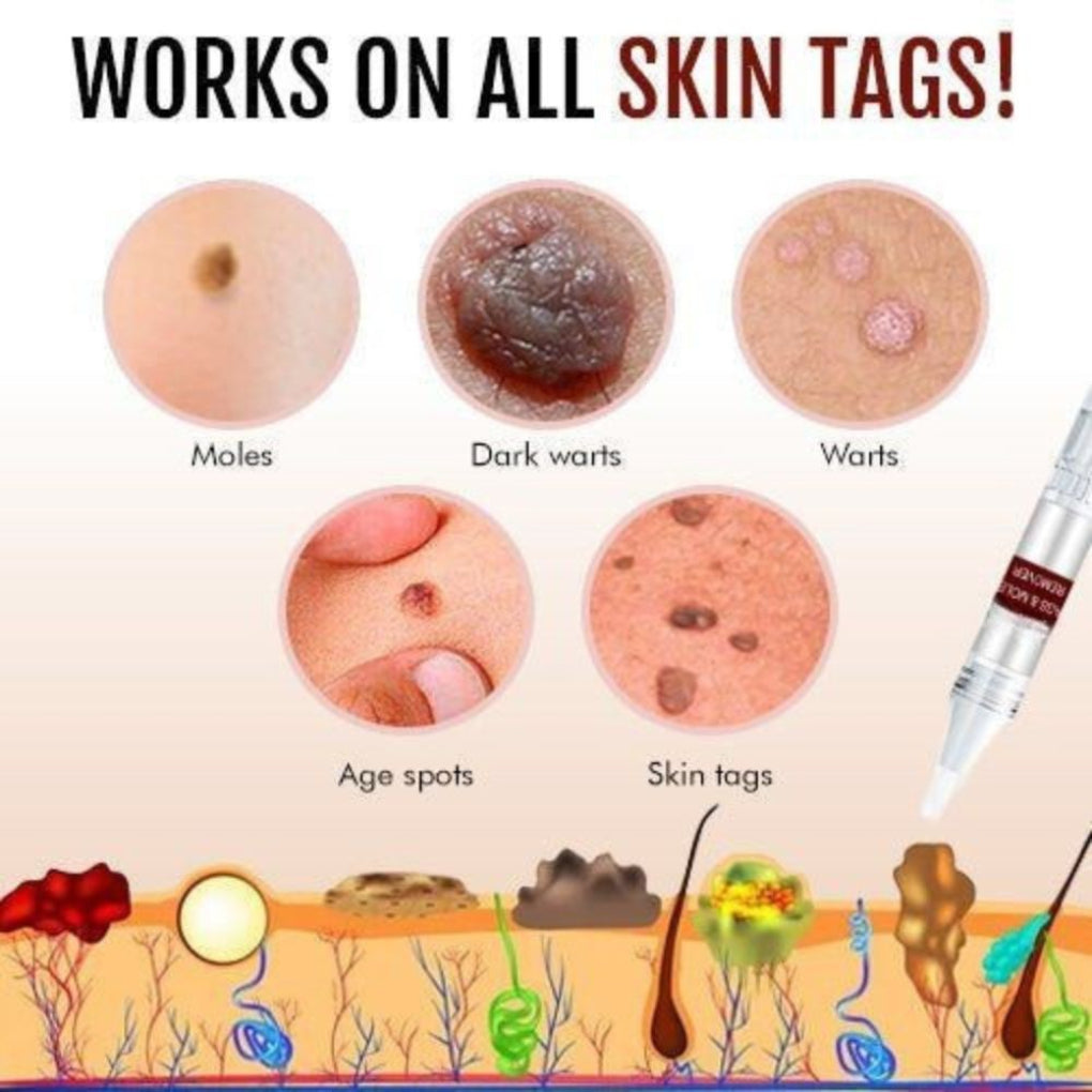 Skin Tag Remover Pen – photo 2