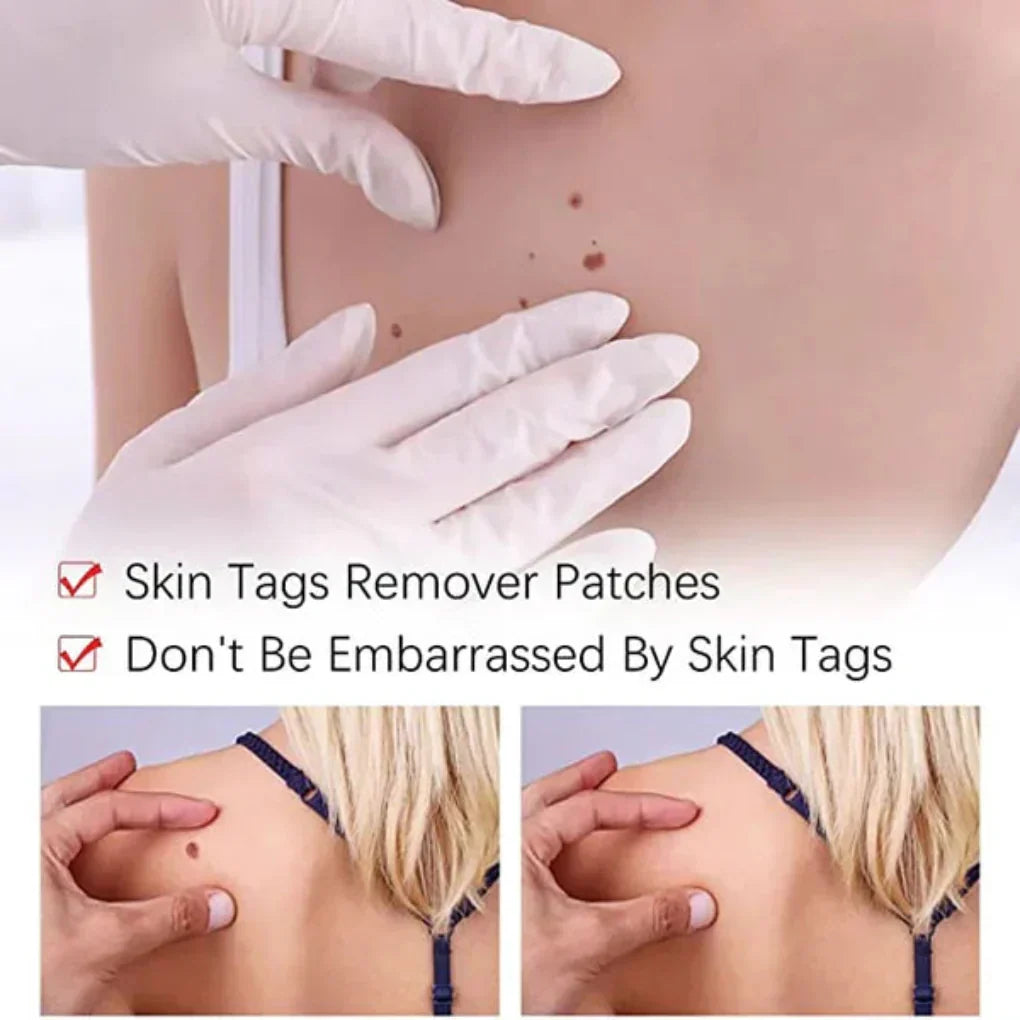 Skin Tag Remover Pen – photo 3