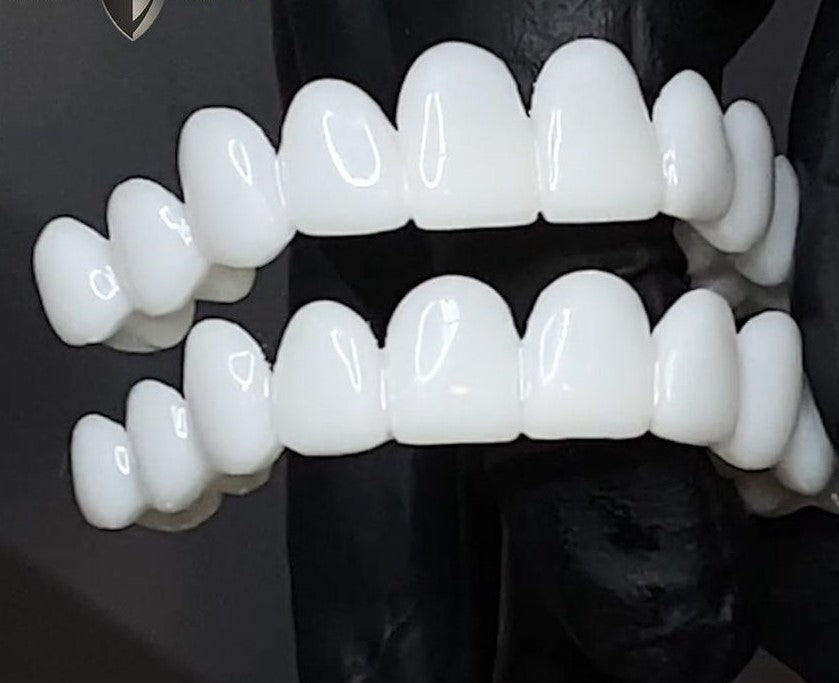 Snap-On Cosmetic Veneers – photo 5