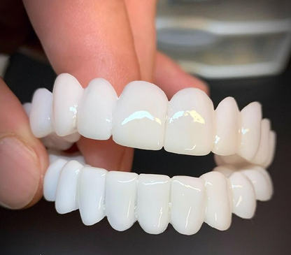 Removable Dental Veneers
