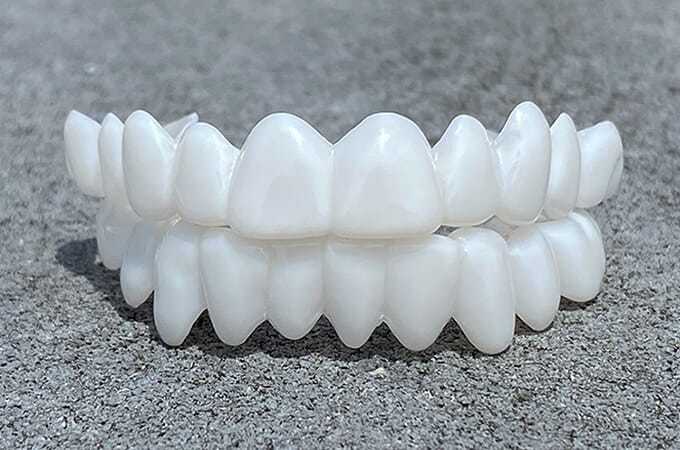 Removable Dental Veneers – photo 2