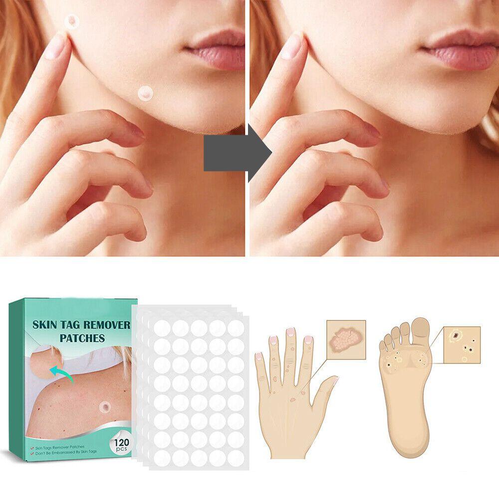 Wart Removal Patches – photo 3