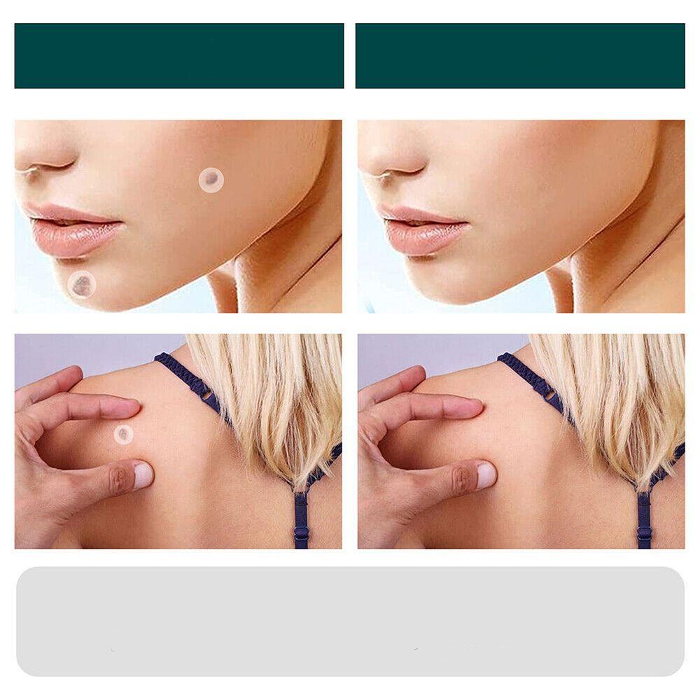 Wart Removal Patches – photo 6