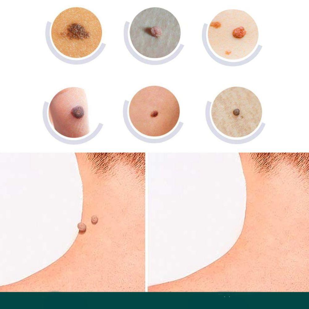 Wart Removal Patches – photo 7